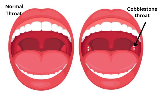 Cobblestone Throat Pictures Causes Symptoms Risks Treatment 