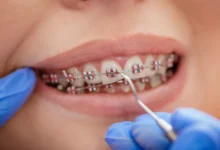 Braces and Gum Swelling