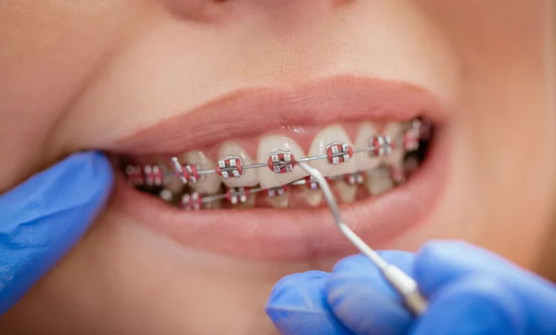 Braces and Gum Swelling